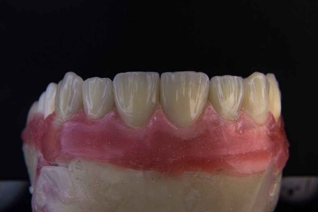 CEREC Same-Day Restorations