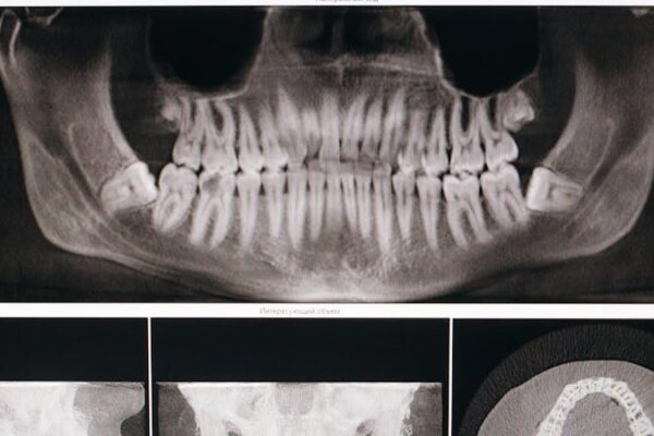 The Safety of Dental X-Rays