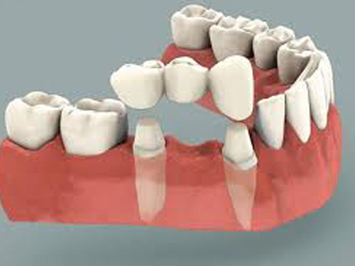 Dental Bridge