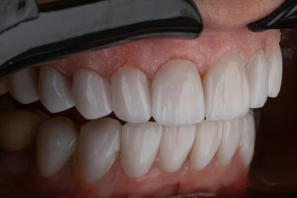 Benefits of Teeth Whitening